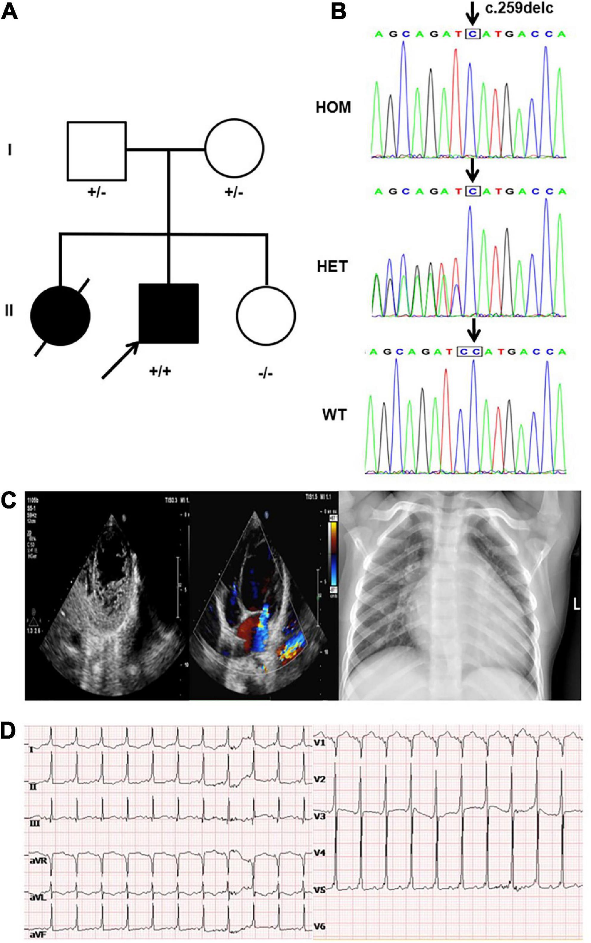 A novel loss-of-function mutation in NRAP is associated with left ventricular non-compaction cardiomyopathy